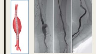 Popliteal artery aneurysm | PPT