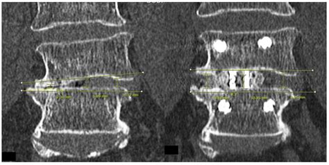 Brain Sciences Free Full Text Uniportal Full Endoscopic