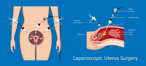 Ovarian Cysts Dr Ng Kai Lyn Female Gynaecologist Laparoscopy