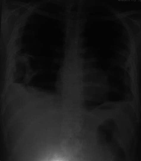 Chest X‐ray showing bilateral consolidation of lungs | Download Scientific Diagram