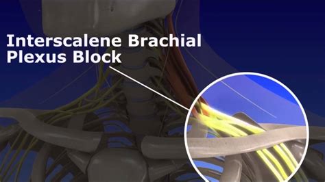 Interscalene Brachial Plexus Block Youtube