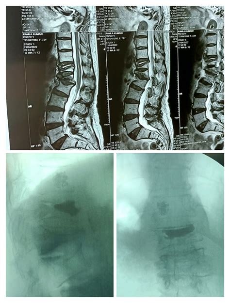 Osteoporotic Vertebral Compression Fracture Vert