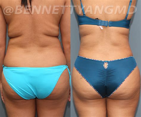 Vaser Liposuction Lipo360 Before And After Pictures