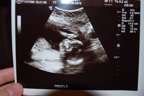 Following The Kies Family: 19 week Ultrasound...........