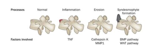 20. spondyloarthropathies and other HLA B27-related disease (MSK YR2 ... 