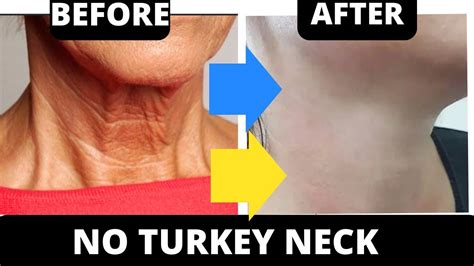 Effective Facial Exercises For Neck Lines Remove Turkey Neck Youtube