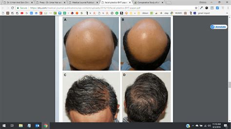 Dr Umar Body Hair Transplant Results 1 – Hair Restoration News Worldwide