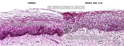 Photograph Cervical Intraepithelial Neoplasia Ci Science Source Images