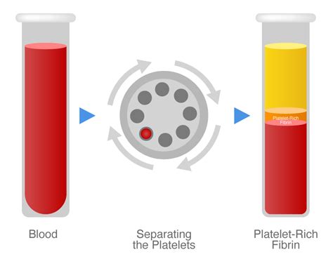 Platelet Rich Fibrin Prf Dental Clinique