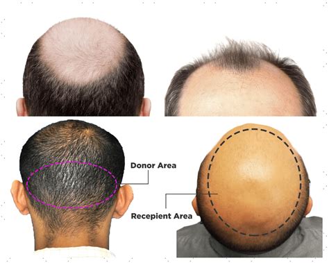 5 Top Reasons To Choose Bht Hair Transplant Clinic Madhapur Cyber