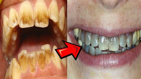 What Causes Teeth To Turn Black Youtube