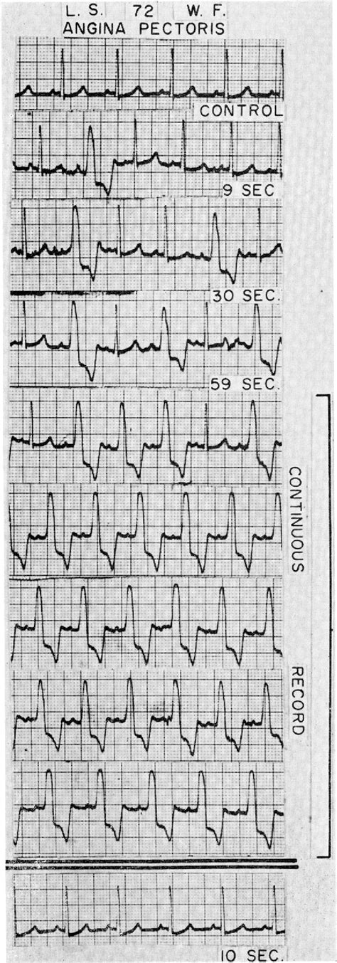 Figure From Radioelectrocardiography During Exercise Table