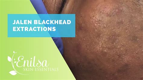 Jalen Blackhead Extractions More Youtube