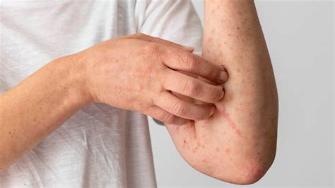 Boehringer Ingelheim Lanza Una Web Sobre Psoriasis Pustulosa