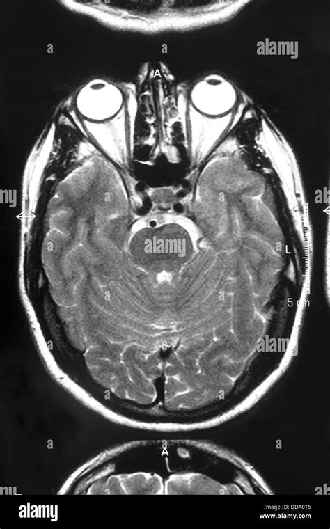 Axial View Of A Human Brain Section Stock Photo Royalty Free Image