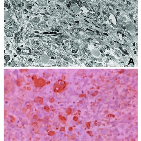 A Photomicrograph Of The Tumor Showing Complicated Fascicles Of