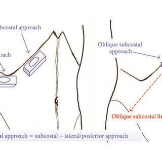 Subcostal Approach Of Transversus Abdominis Plane Tap Block A The