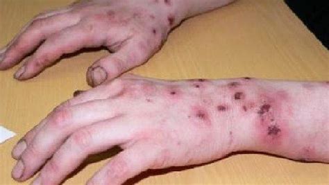 Krokodil Gli Effetti Devastanti Della Nuova Droga Che Arriva Dalla