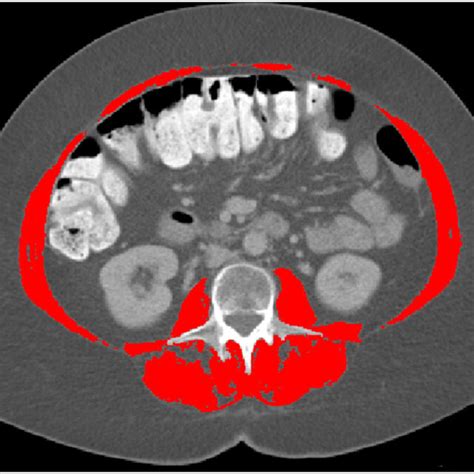 Abdominal Axial Ct Scan Of An Ovarian Cancer Patient Taken At The Third