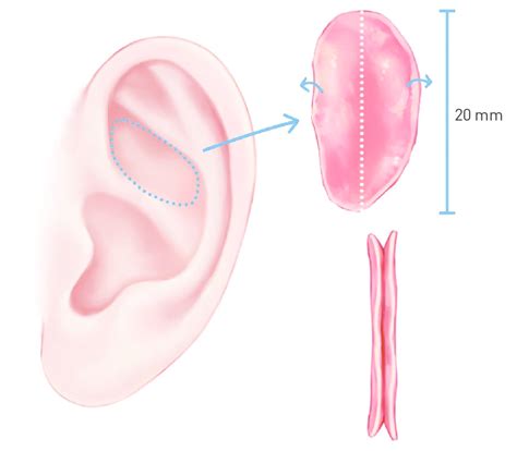 Cymba of the concha cartilage harvested from the ear. | Download Scientific Diagram