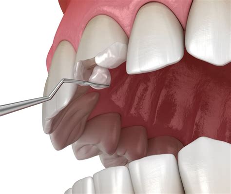 Implante dentário cuidados pós operatório que o paciente deve ter