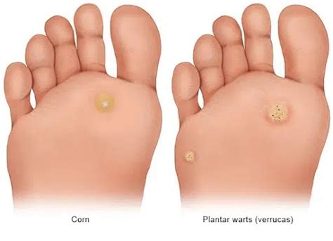 What Is The Difference Between A Corn And A Wart Differences Finder