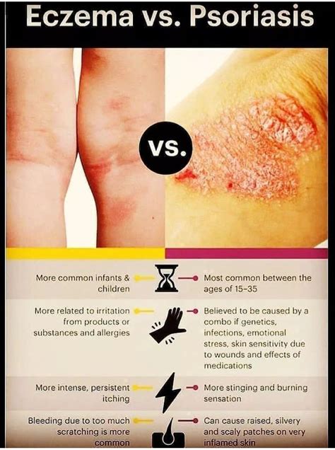 Eczema Vs Psoriasis Medizzy