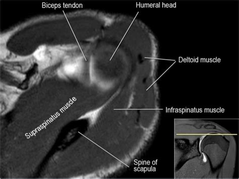 Mri Musculo Skeletal Section Mri Anatomy Of The Shoulder Axial View