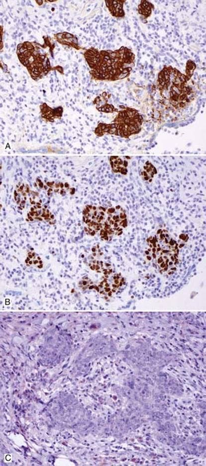 Small Cell Variant Of Squamous Cell Carcinoma Scc Thoracic