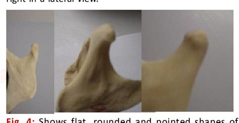 Table 1 from MORPHOLOGY OF CONDYLOID PROCESS OF MANDIBLE AND IT’S SURGICAL RELEVANCE | Semantic ...