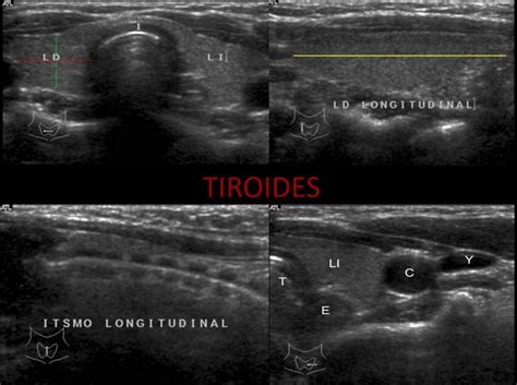 35 Protocolo De Tiroides Consideraciones Básicas Ecografía Fácil