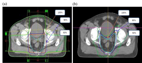 Physical And Radiobiological Evaluation Of Radiotherapy Treatment Plan