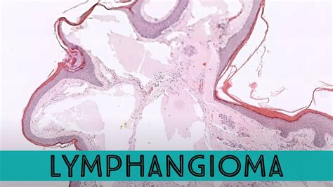 Lymphangioma Histology