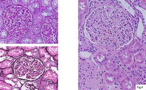 Diagnosis Of Amyloidosis Clinicopathological Advances And Challenges