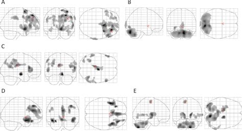 Apomorphine Pump In Advanced Parkinsons Disease Effects On Motor And