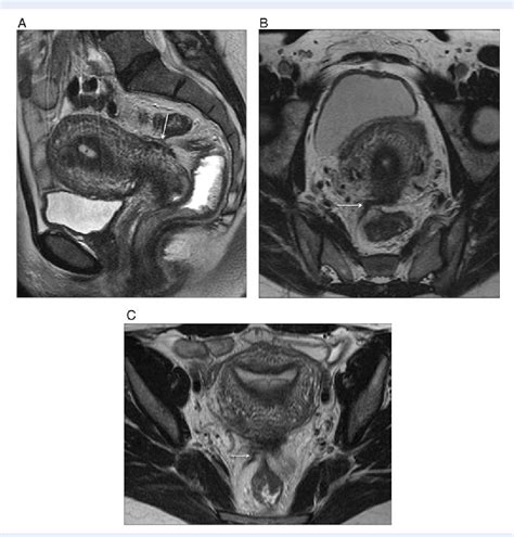 Uterosacral Ligament Mri