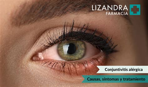 ¿qué Es La Conjuntivitis Alérgica Síntomas Y Tratamiento Blog De