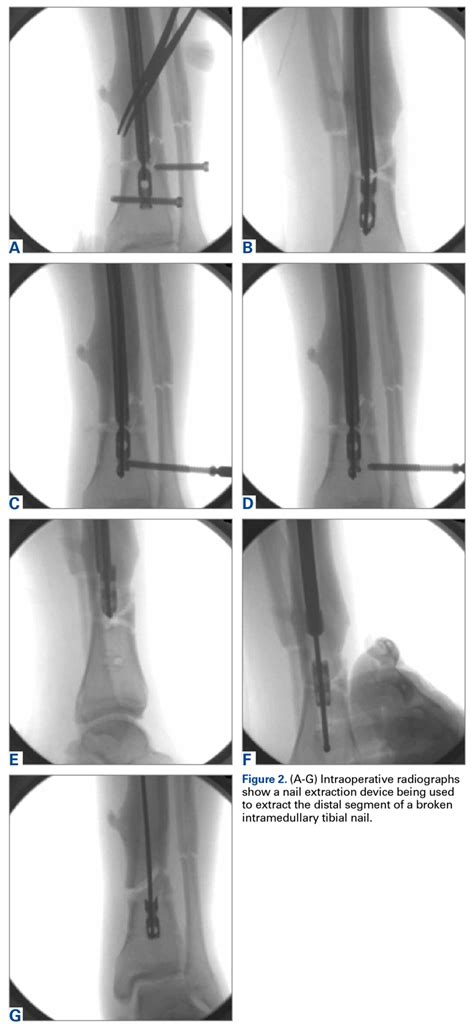 Discover more than 128 intramedullary nail tibia latest - in.coedo.com.vn