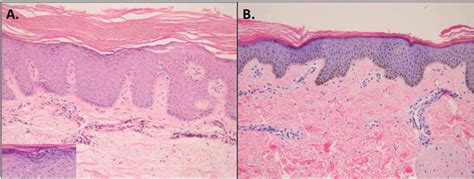 Figure 1 From Comparing Histopathology From Patients With X Linked