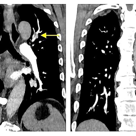 The Computed Tomography Pulmonary Angiogram Showed A Moderate Burden Of Download Scientific