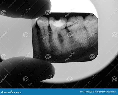 The Result Of X Ray Radiography Of The Teeth Of The Oral Cavity Of The