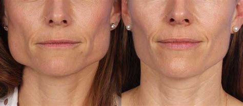 4 Types of Jawline Reduction and Enhancement