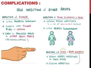 Herpes simplex infection(Hsv) | PPT