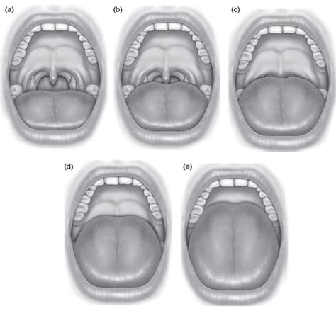 Tonsil Size Grading Scale and Tongue Position Grading System