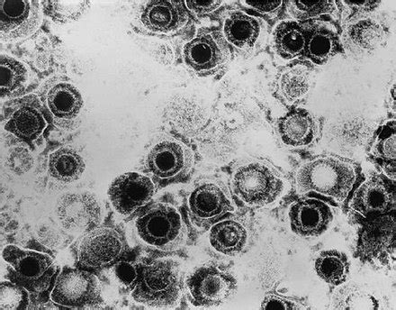 Virus Dell Herpes Simplex Wikipedia