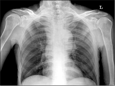 The chest posteroanterior radiograph shows a bamboo spine. | Download ...