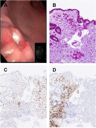 Full Article Exceptional Symbiosis Between Tumors A Case Of Gastric