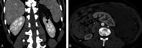 A A 41 Year Old Man With Exophytic Renal Angiomyolipoma And B A