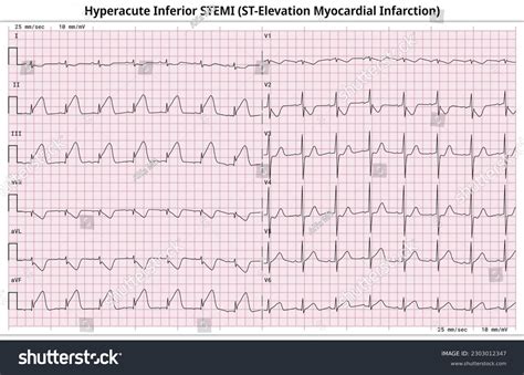 Hyperacute Inferior Stemi St Elevation Myocardial Infarction Stock