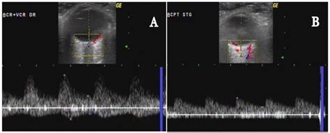 Color Doppler Ultrasonography Of Intraorbital Arteries A Central